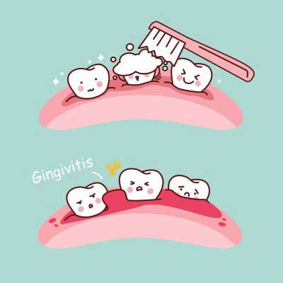 Diagram of a gingivitis