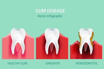 Gum Disease