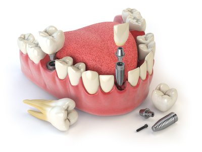 Dental implant