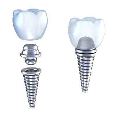 Dental implant