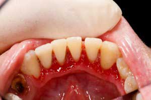 Periodontal Disease