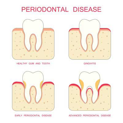 Periodontal disease