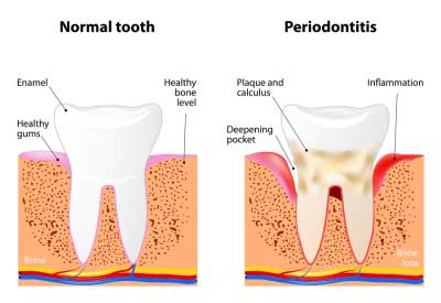 Gum disease