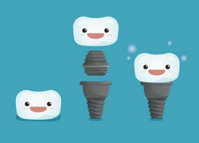 Dental implant