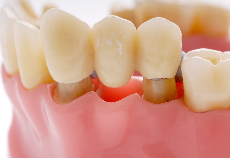 Dental bridge placement showing crowns in Westlake, OH