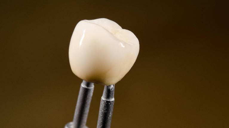 Dental veneers treatment by Dental Care of Westlake in Westlake, OH